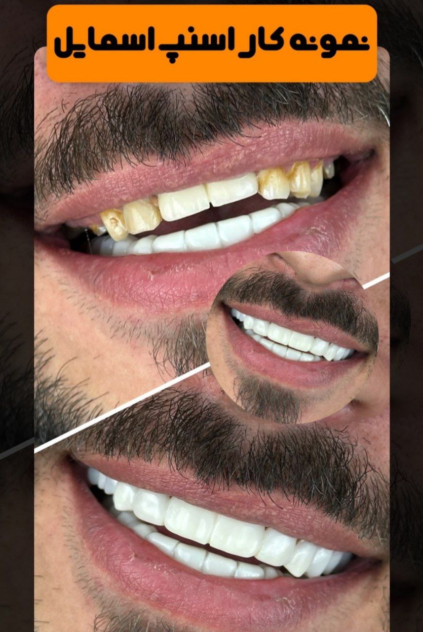  لمینت دندان دو فک اصلی برای خرابی 10 دندان vision10 دکترفروش